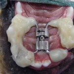 Fertig angepasste Dehnschraube zur Korrektur des 2. Schneidezahnes auf der rechten Seite - Hund Zahnspange Gebissregulierung Dehnschraube 3